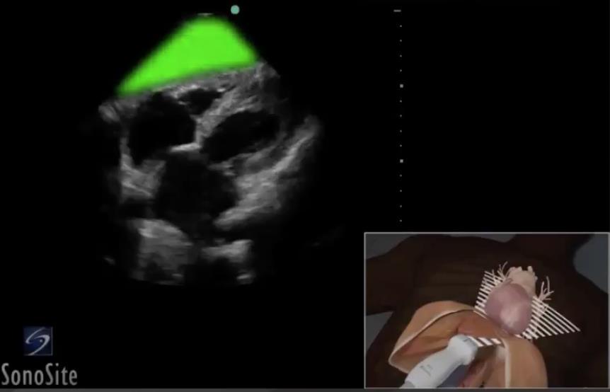 Heart Subcostal View Liver Highlighted Image Sonosite Institute For